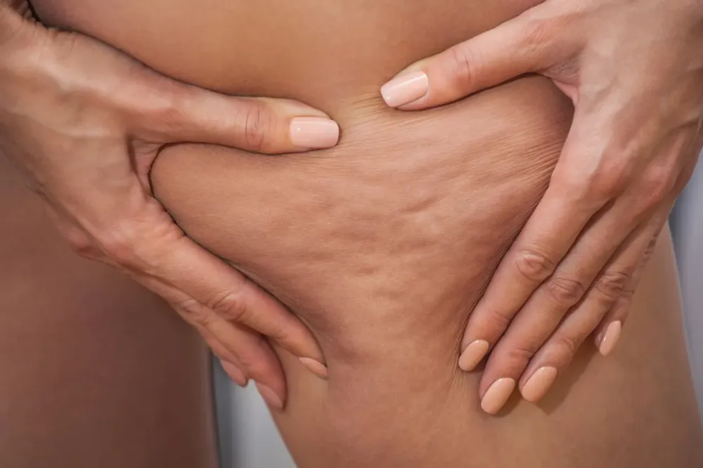 Cellulite à Bagnols-sur-Cèze